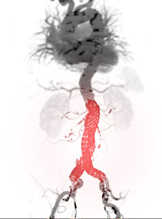 CTA whole aorta with Abdominal aorta stent graft 3D rendering image in case  abdominal aortic aneurysms.の写真素材