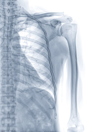 X-ray left Humerus bone for diagnosis fracture of Humerus bone .