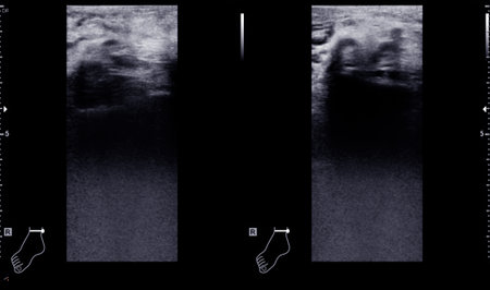Color Doppler ultrasound determination in deep vein thrombosis patients for finding  deep vein...
