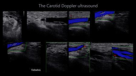 A carotid artery Doppler ultrasound is a diagnostic test used to check the arteries in the neck for...