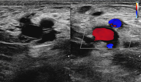 A carotid artery Doppler ultrasound is a diagnostic test used to check the arteries in the neck for...