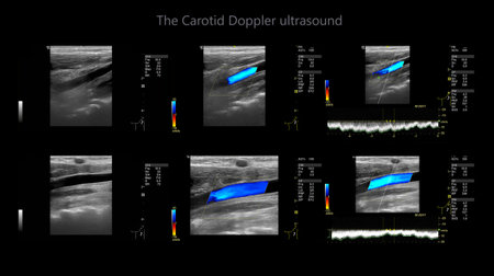 A carotid artery Doppler ultrasound is a diagnostic test used to check the arteries in the neck for...