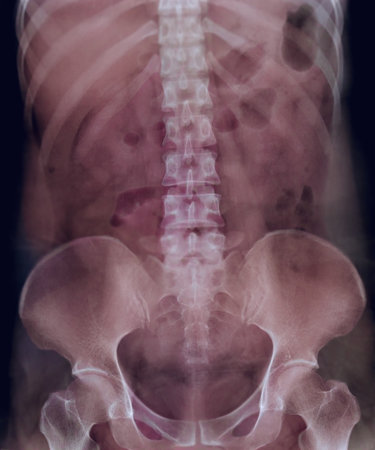 Intravenous pyelogram or I.V.P is an X-ray exam of urinary tract after injection contrast media...