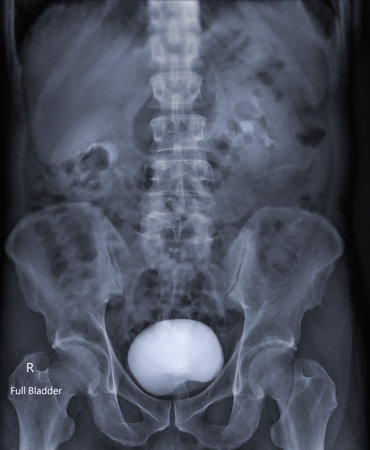 Intravenous pyelogram or I.V.P is an X-ray exam of urinary tract after injection contrast media agent  .の写真素材