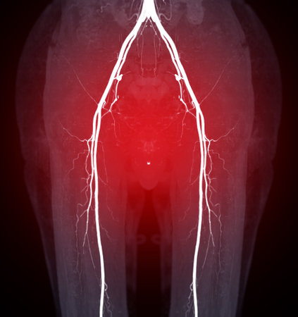 CTA femoral artery run off image of femoral artery for diagnostic  Acute or Chronic Peripheral Arterial Disease.の写真素材