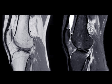 Magnetic resonance imaging or MRI of  knee joint Sagittal PDW and T2 FS for detect tear or sprain of the anterior cruciate  ligament (ACL)の写真素材