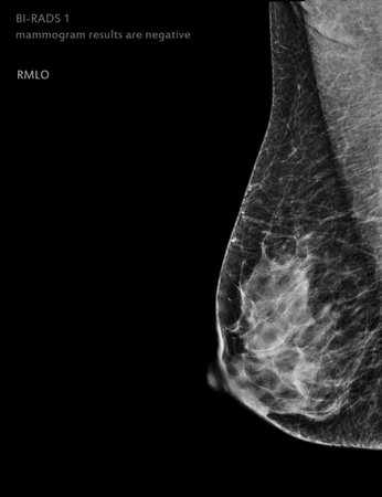X-ray Digital Mammogram left side MLO view . mammography or breast scan for Breast cancer BI-RADS 1 mammogram results are negative.の写真素材