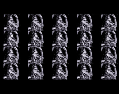 MRI heart or Cardiac MRI ( magnetic resonance imaging ) of heart for diagnosis heart disease.の写真素材
