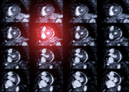MRI heart or Cardiac MRI ( magnetic resonance imaging ) of heart for diagnosis heart disease.の写真素材