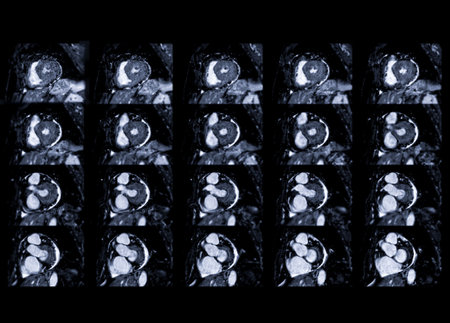 MRI heart or Cardiac MRI ( magnetic resonance imaging ) of heart for diagnosis heart disease.の写真素材