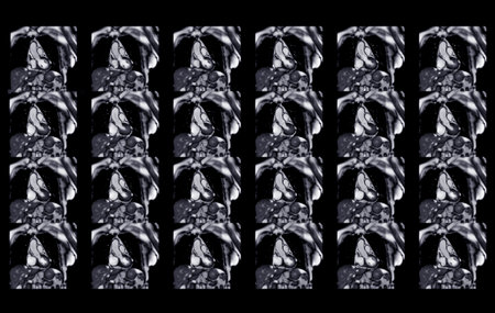 MRI heart or Cardiac MRI ( magnetic resonance imaging ) of heart for diagnosis heart disease.の写真素材