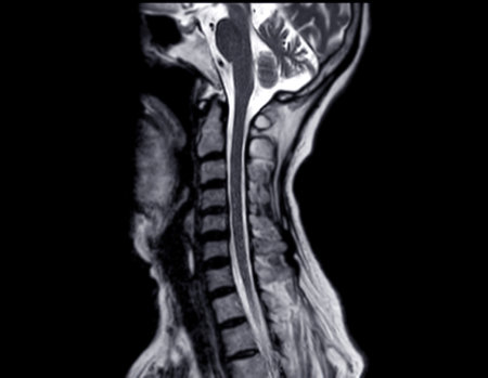 MRI of  C-spine or magnetic resonance image of cervical spine sagittal view  for diagnosis spondylosis causing cervical spondylotic myelopathy and compression fracture.の写真素材