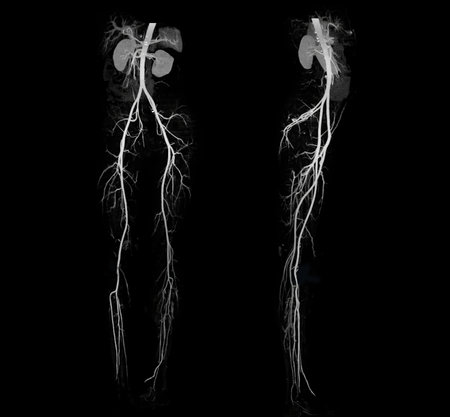 CTA femoral artery run off showing  femoral artery for diagnostic  Acute or Chronic Peripheral Arterial Disease.の写真素材
