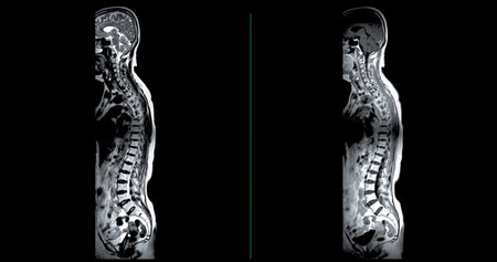 MRI whole spine screening for diagnosis spinal cord compression.の写真素材