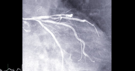 Cardiac catheterization on  left anterior descending artery (LAD) can help doctor diagnose and treat problems in your heart and blood vessels  such as a heart attack or stroke.の写真素材