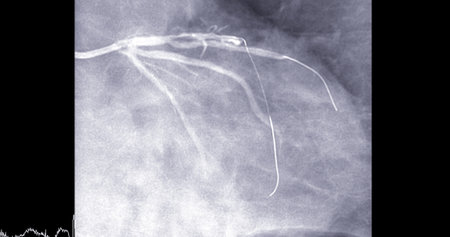 Cardiac catheterization on  left anterior descending artery (LAD) can help doctor diagnose and treat problems in your heart and blood vessels  such as a heart attack or stroke.の写真素材