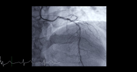 Cardiac catheterization on  left anterior descending artery (LAD) can help doctor diagnose and treat problems in your heart and blood vessels  such as a heart attack or stroke.の写真素材