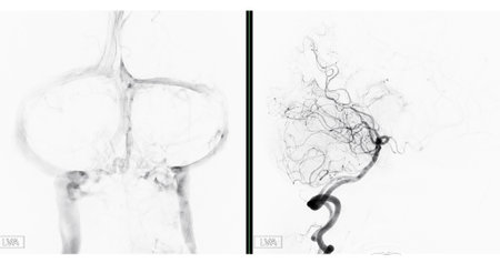 Cerebral angiography  image from Fluoroscopy in intervention radiology  showing cerebral artery.の写真素材