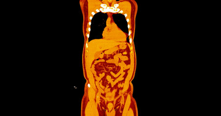 CT Chest and Abdomen with injection contrast media coronal view for diagnosis chest and  abdominal pain.の写真素材