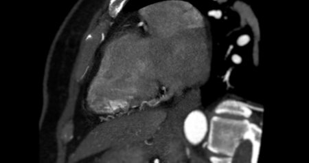 CTA Coronary artery vertival long axis view for diagnosis of vessel coronary artery stenosis.の写真素材