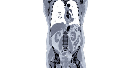 CT Chest and Abdomen with injection contrast media coronal view for diagnosis chest and  abdominal pain.の写真素材