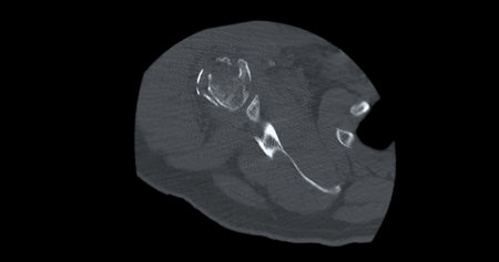 CT Scan of Shoulder joint in case  fracture shoulder joint.の写真素材