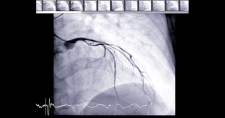 Cardiac catheterization on  left anterior descending artery (LAD) can help doctor diagnose and treat problems in your heart and blood vessels  such as a heart attack or stroke.の写真素材
