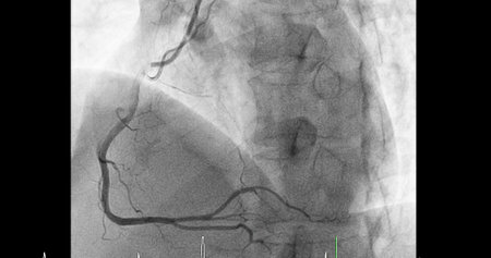 Cardiac catheterization on right coronary artery (RCA) can help doctor diagnose and treat problems in your heart and blood vessels  such as a heart attack or stroke.の写真素材