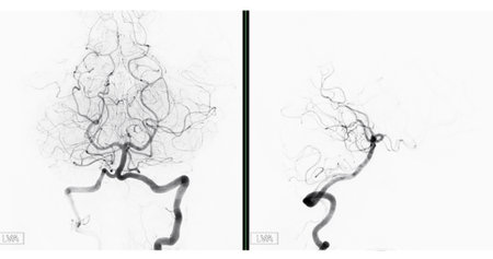 Cerebral angiography  image from Fluoroscopy in intervention radiology  showing cerebral artery.の写真素材