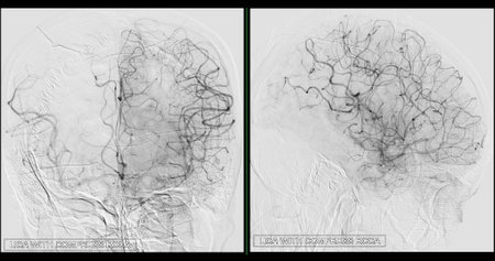 Cerebral angiography  image from Fluoroscopy in intervention radiology  showing cerebral artery.の写真素材