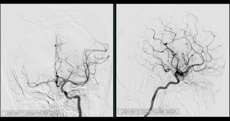 Cerebral angiography  image from Fluoroscopy in intervention radiology  showing cerebral artery.の写真素材