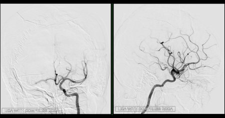 Cerebral angiography  image from Fluoroscopy in intervention radiology  showing cerebral artery.の写真素材