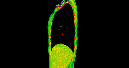 CT scan of Chest sagittal view in color mode  for diagnostic Pulmonary embolism (PE) , lung cancer...
