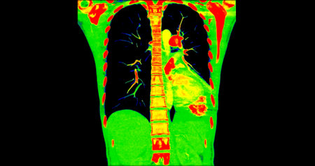 CT scan of Chest coronal view in color mode  for diagnostic Pulmonary embolism (PE) , lung cancer and covid-19.の写真素材