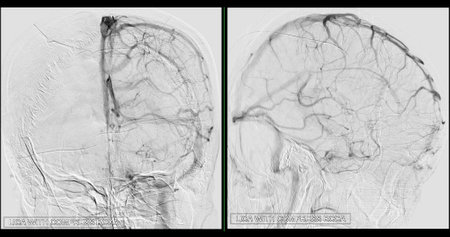 Cerebral angiography  image from Fluoroscopy in intervention radiology  showing cerebral artery.の写真素材