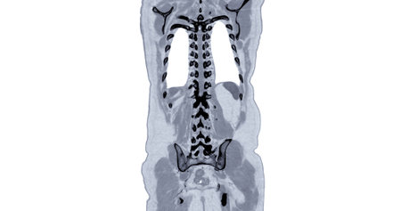 CT Chest and Abdomen with injection contrast media coronal view for diagnosis chest and  abdominal...