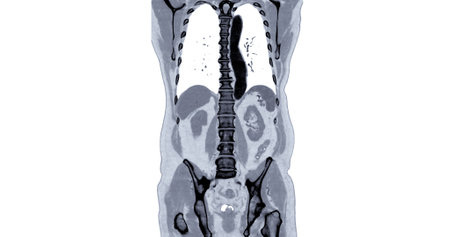 CT Chest and Abdomen with injection contrast media coronal view for diagnosis chest and  abdominal pain.の写真素材