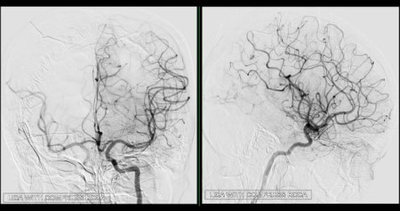 Cerebral angiography  image from Fluoroscopy in intervention radiology  showing cerebral artery.の写真素材
