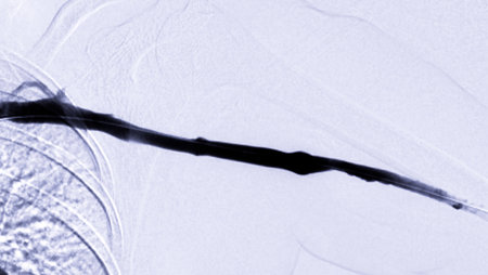Image of Angioplasty, balloon angioplasty and percutaneous transluminal angioplasty (PTA) .の写真素材