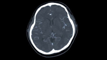 CT scan of the brain with injection contrast media  for diagnosis brain tumor,stroke diseases and vascular diseases.の写真素材