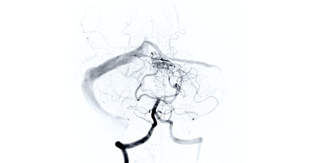 Cerebral angiography  image from Fluoroscopy in intervention radiology  showing cerebral artery.