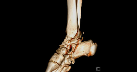 CT Scan ankle joint  or Computed Tomography of Ankle joint 3D  Rendering image .の写真素材
