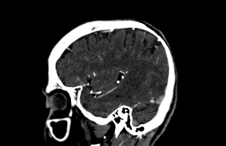 CT scan of the brain sagittal  plane for diagnosis brain tumor,stroke diseases and vascular diseases.の写真素材