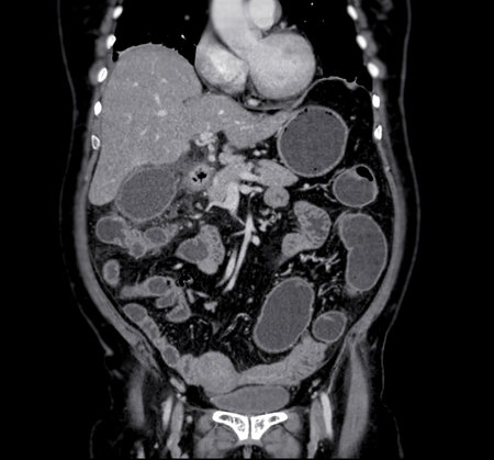 CT scan of  whole abdomen with contrast  media coronal view.の写真素材
