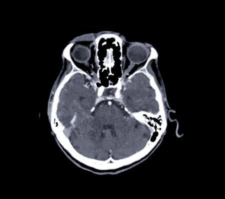 CT scan of the brain Axial  plane for diagnosis brain tumor,stroke diseases and vascular diseases.