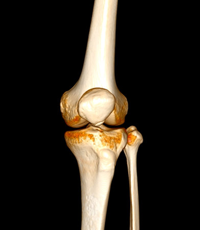 CT Scan of  Knee joint 3D rendering Showing fracture of Patella .の写真素材