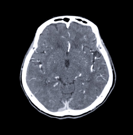 CT scan of the brain Axial  plane for diagnosis brain tumor,stroke diseases and vascular diseases.の写真素材