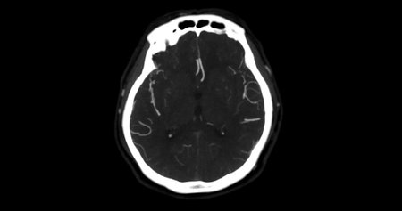 CTA BRAIN or CT angiography of the brain  axial mip view showing  cerebral artery.の写真素材