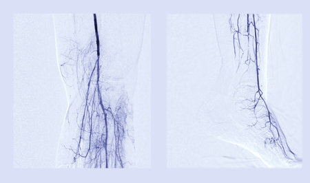 Foot angiorgam or Plantar angiogram angiogram showing  Plantar and Tarsal  Artery at foot area.の写真素材