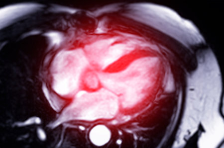 MRI heart or Cardiac MRI ( magnetic resonance imaging ) of heart 4 chamber view for diagnosis heart...